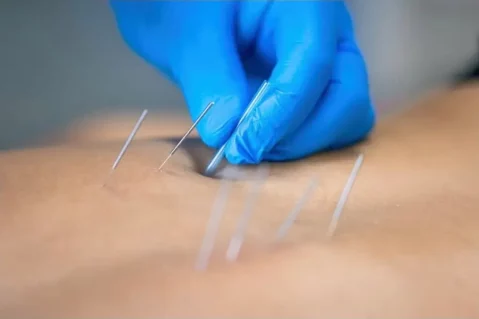 Dry-Needling – Thérapie myofasciale et points trigger